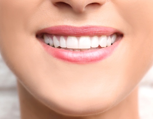 Closeup of woman's teeth with cosmetic dental bonding in Boerne