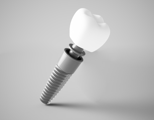 Animated dental implant components