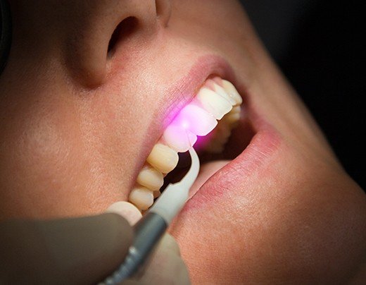 Patient receiving soft tissue laser dentistry