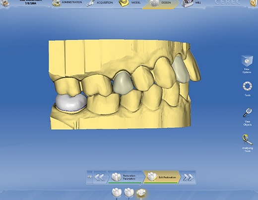 CEREC dental crown design on computer screen