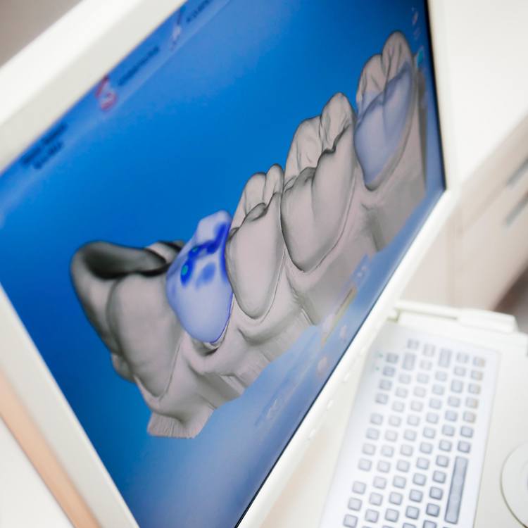 CEREC digital dental crown design on computer screen