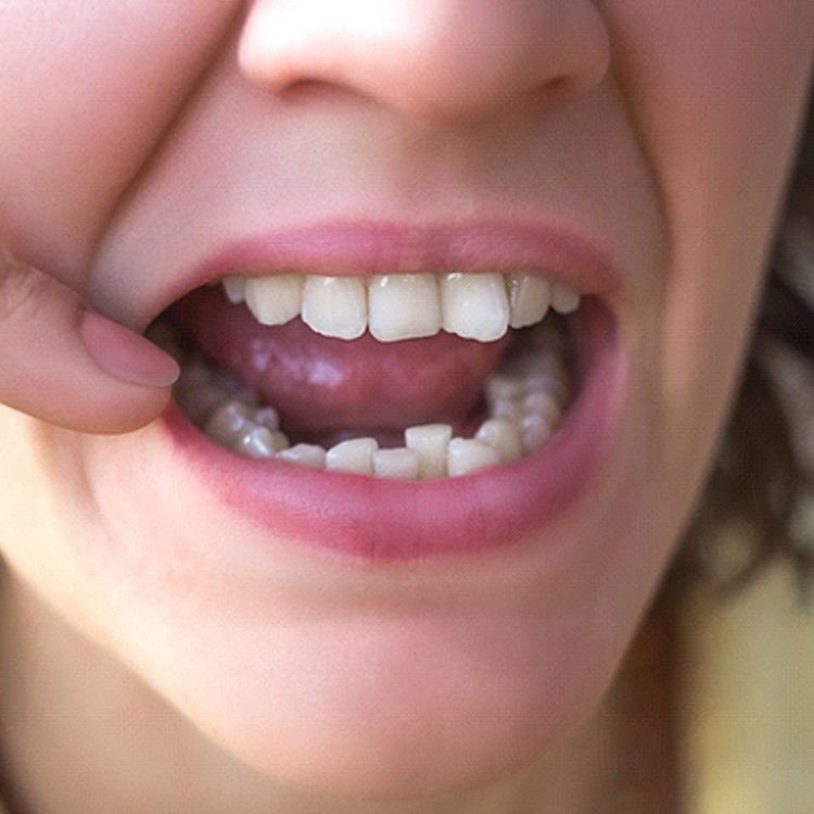 crowded teeth needing clear aligners
