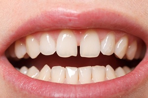 crowded teeth needing clear aligners