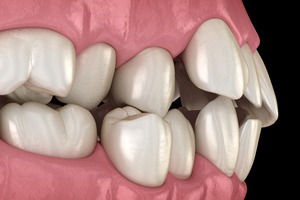 gapped teeth