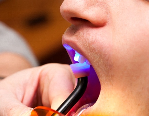 Cosmetic dentist in Boerne using dental light