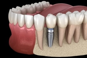 Animated dental implant supported dental crown