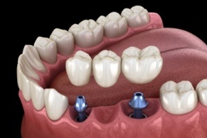 Animated dental implant supported fixed bridge