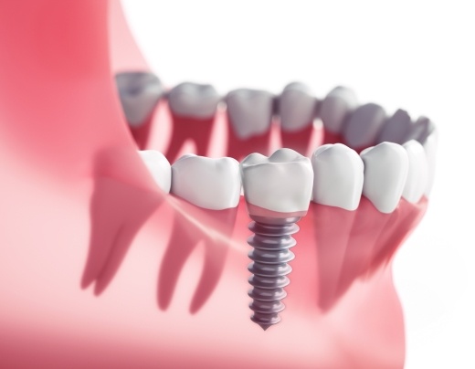 Animated dental implant supported replacement tooth