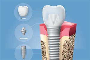 A graphic that explains each part of the dental implant