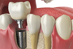 A digital image of a single tooth dental implant sitting between two healthy teeth in the lower arch