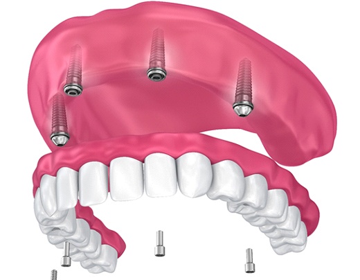 implant denture being placed in the upper arch