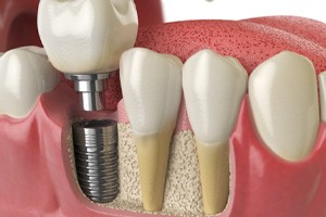 implant and abutment representing how dental implants work in Boerne