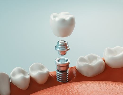 Animation of dental implant placement