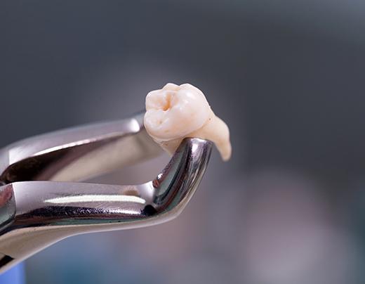 Metal clasp holding extracted tooth