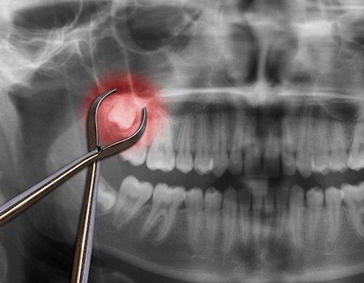 X-ray of impacted wisdom tooth