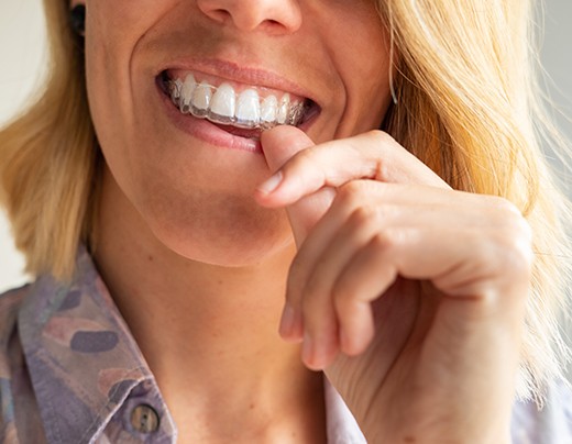 Woman pushing clear aligner onto her teeth