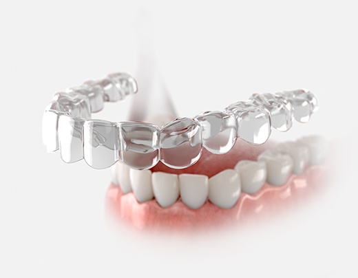 Illustration of clear aligner and teeth