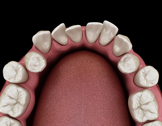Top-view illustration of crowded teeth