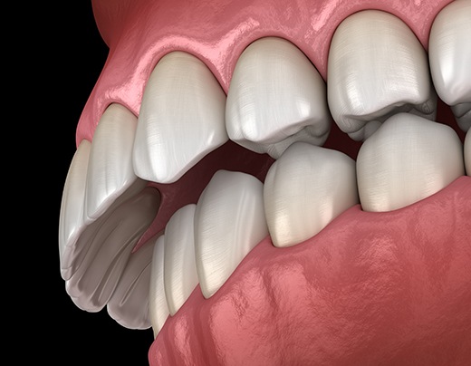 Illustration of an overbite against dark background