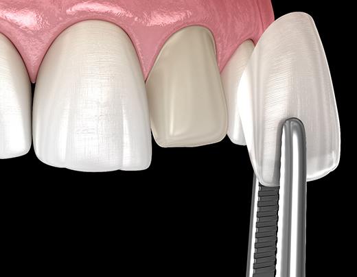 Placing veneers in Boerne, TX on teeth