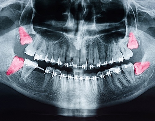 X-ray of wisdom teeth in Boerne