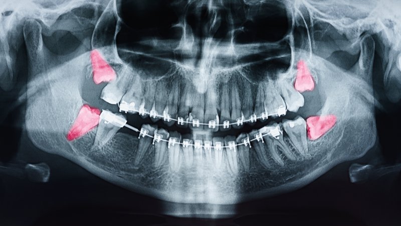 a digital x-ray that highlights the four wisdom teeth