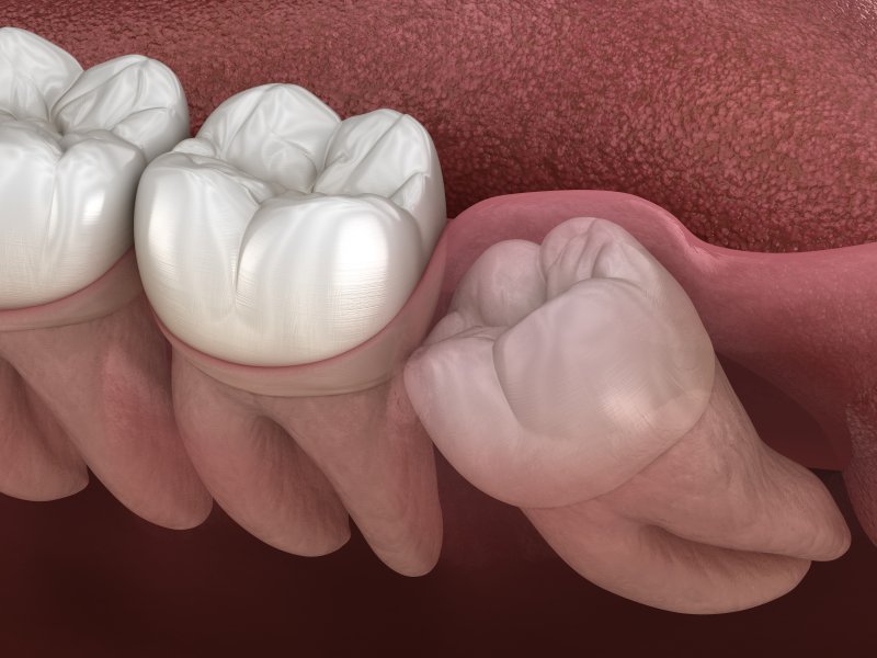 Wisdom tooth impacted under the gums