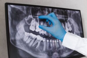 Gloved hand pointing at tooth on X-ray